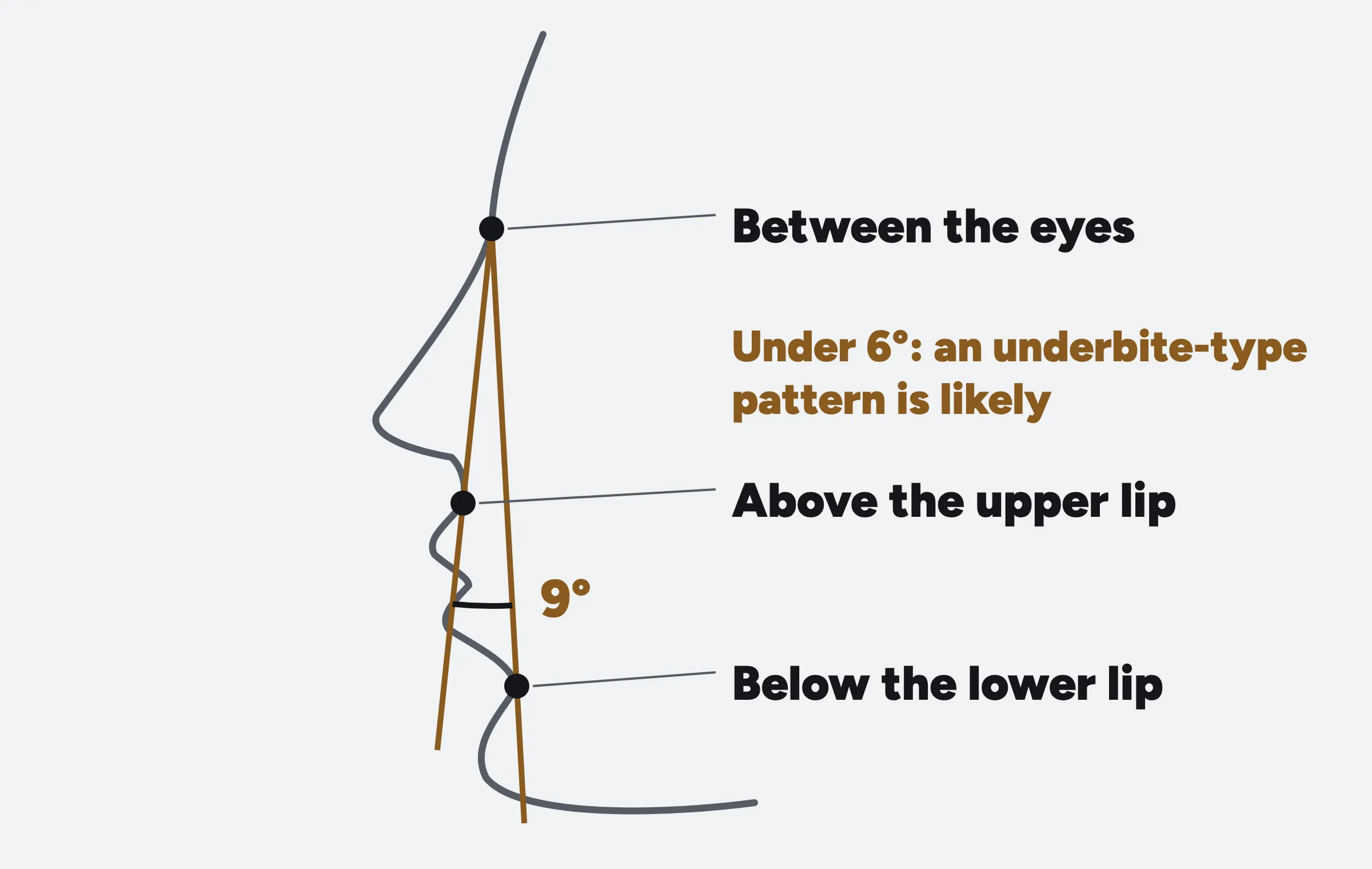 Diagram of a side profile with three points marked: between the eyes, above the upper lip and below the lower lip. Two lines from the top point form an angle of 9 degrees in this example; under 6 degrees suggests an underbite-type pattern.