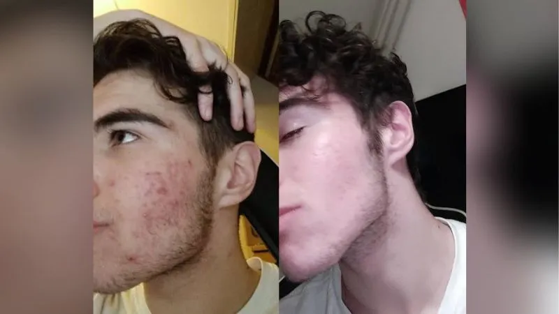 Larsanova acne before and after using Retin-A as part of his looksmaxxing skincare routine