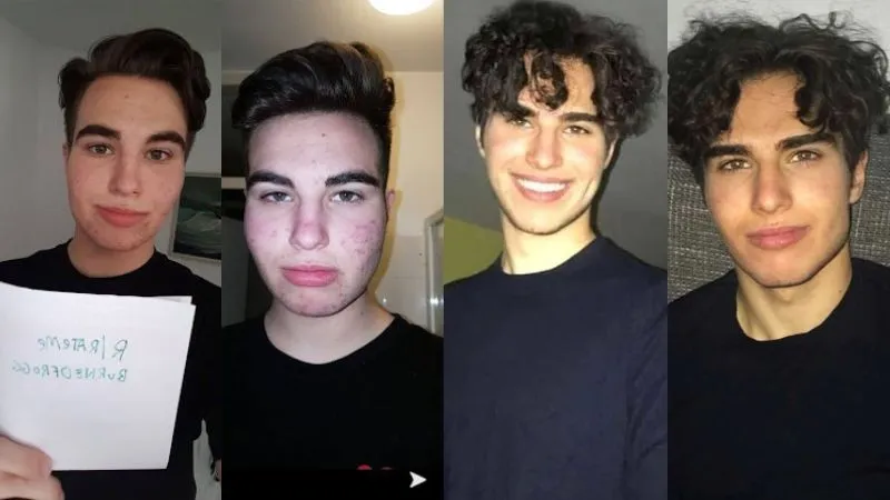 Four photographs of Larsanova side by side: two earlier shots with visible acne and a swept-back fringe, then two later ones with curly hair and clearer skin.