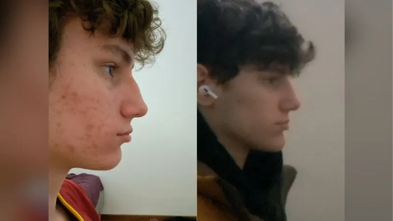 Orka before and after looksmaxxing – side profile comparison showing chin and skin improvements