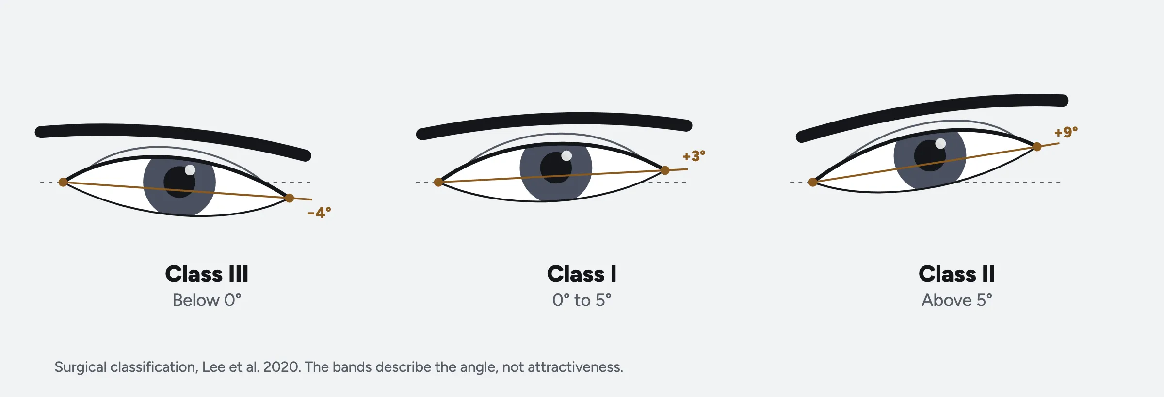 Three eyes drawn at different tilts: minus 4 degrees, labelled class III, below 0; plus 3 degrees, class I, 0 to 5; plus 9 degrees, class II, above 5.