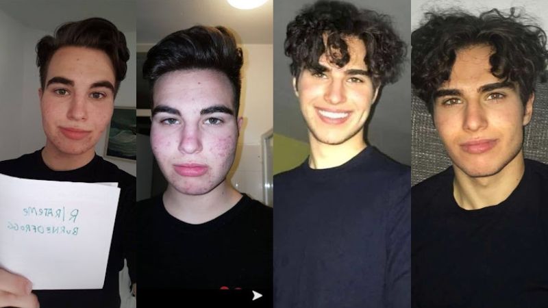 Larsanova before and after looksmaxxing transformation showing acne treatment and facial improvement